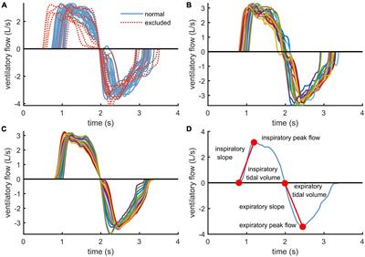 Altered Expiratory Flow Dynamics at Peak Exercise in Adult Men With Well-Controlled Type 1 Diabetes